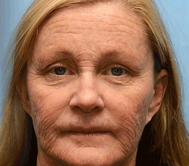 (Made and Shipped from USA) 🧑⚕️ODALIT™ Botox Bee Venom Wrinkle Removal Cream- LAST DAY 70% OFF🔥