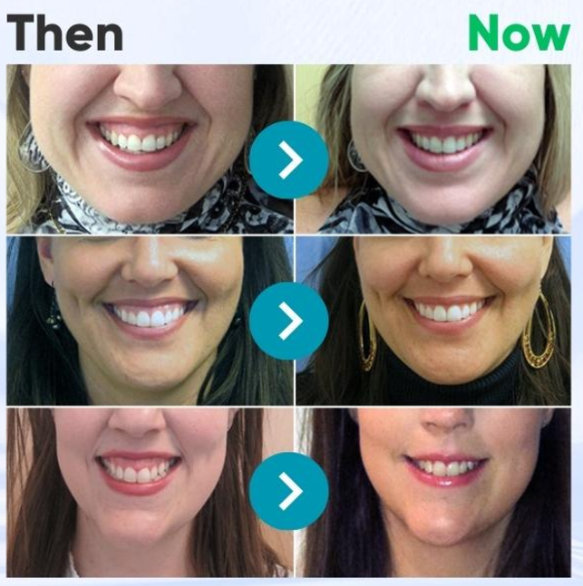 đOfficial Store |đ§đ˝ââď¸ODALIT⢠Focussmile Bee Venom Treatment Oral Powder đڎ(ADA Recommended)