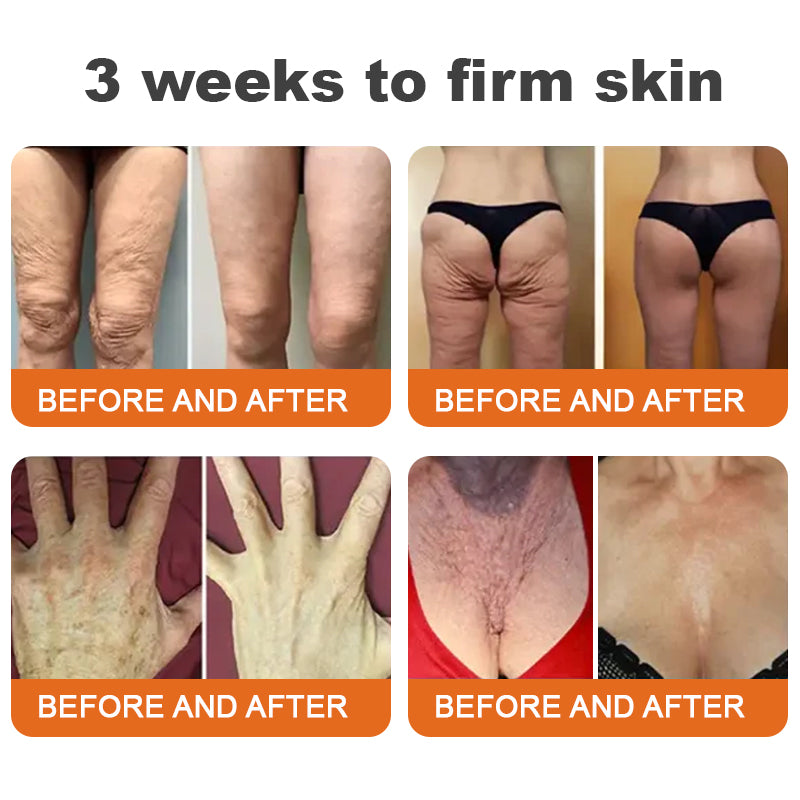 🐝💎Flash Sale - ✨ODEIUN™ BOTOX Bee Venom All-in-one Treatment Cream 🔥 LAST DAY 80% OFF 💎💎