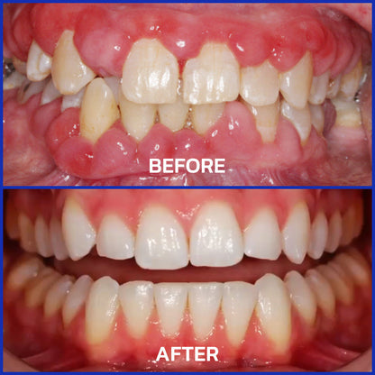 🏆ODALIT™ Focussmile Bee Venom Treatment Oral Powder 🦷(ADA Recommended)