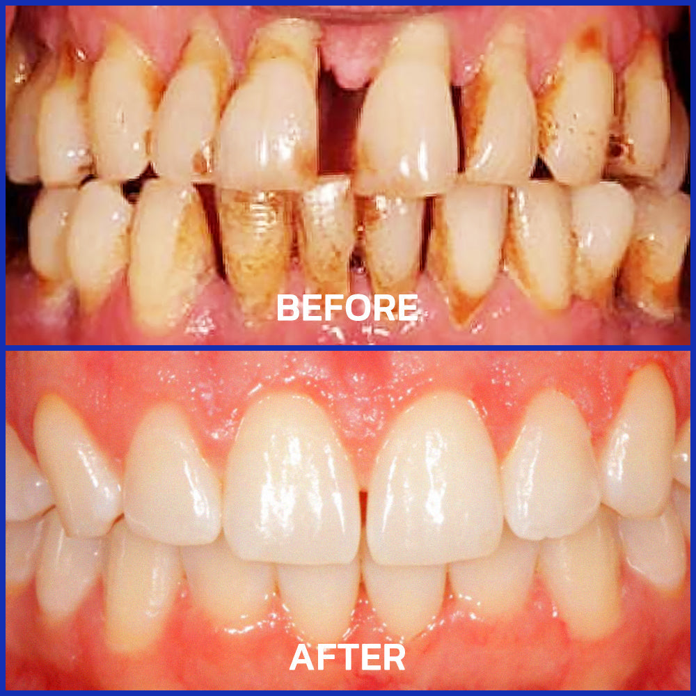 🏆ODALIT™ Focussmile Bee Venom Treatment Oral Powder 🦷(ADA Recommended)